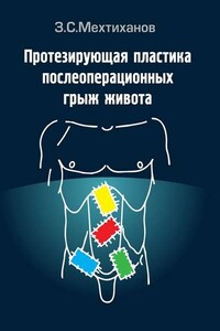 Протезирующая пластика послеоперационных грыж живота